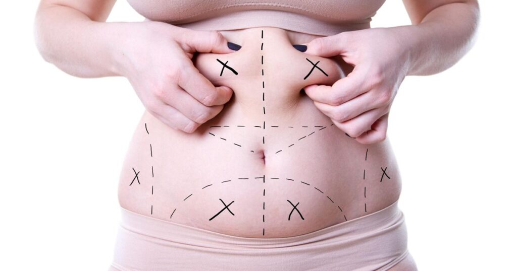 Body Contouring for 2025 Fat Removal Evolved