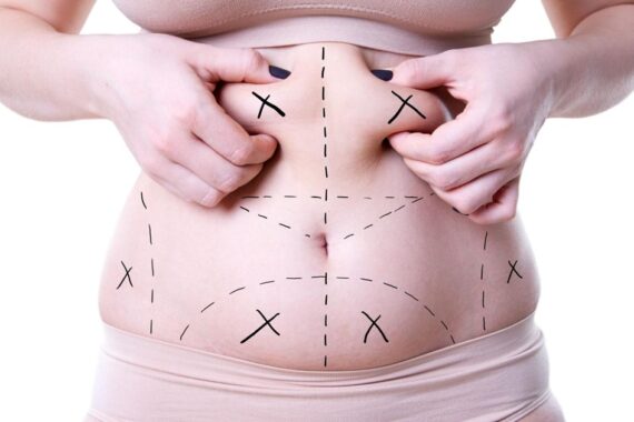 Body Contouring for 2025 Fat Removal Evolved