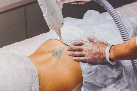 How Laser Tattoo Removal Can Restore Your Natural Skin