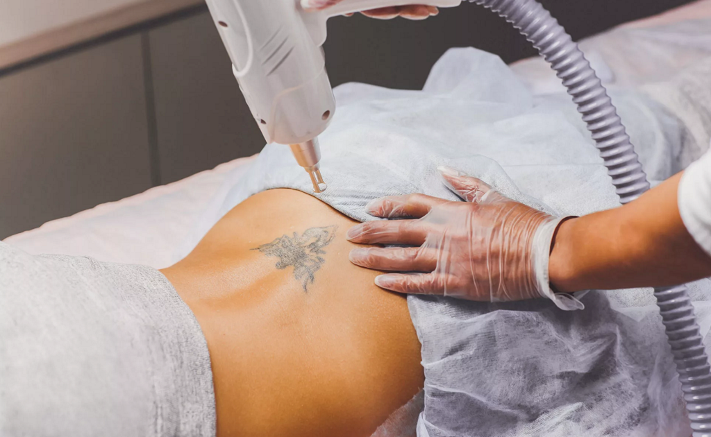 How Laser Tattoo Removal Can Restore Your Natural Skin