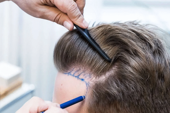 Natural Hair Growth with Advanced Hair Transplant in Islamabad