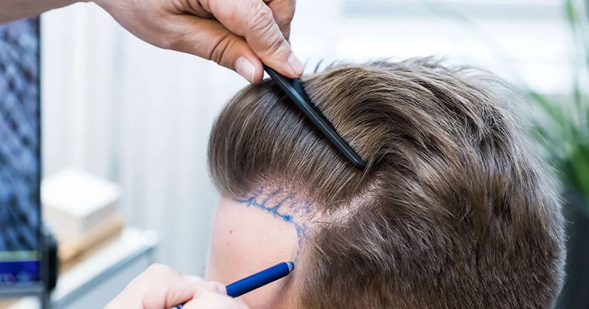 Natural Hair Growth with Advanced Hair Transplant in Islamabad