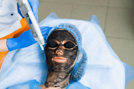Non-Surgical Skin Perfection with Laser Carbon Peel in Islamabad