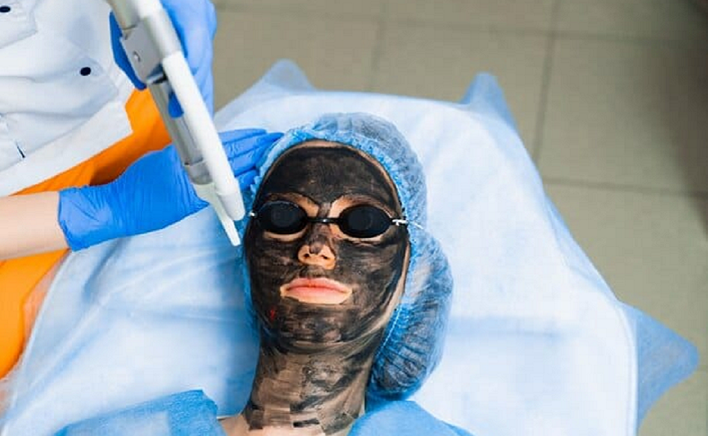 Non-Surgical Skin Perfection with Laser Carbon Peel in Islamabad