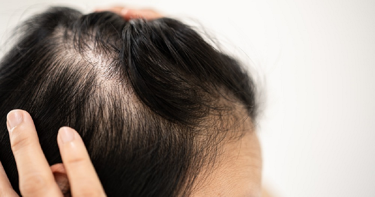 Permanent Hair Restoration Solutions in Islamabad