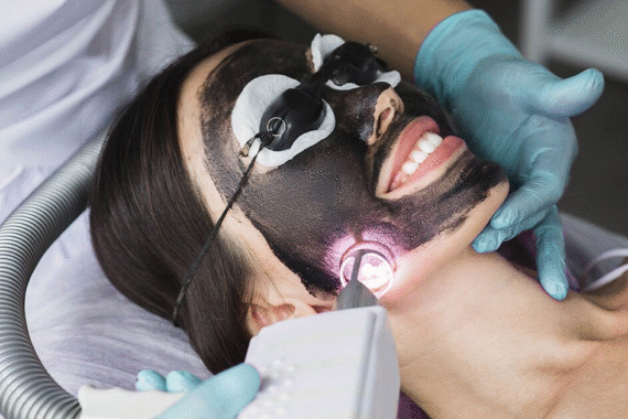 Say Goodbye to Acne and Dull Skin with Carbon Peels