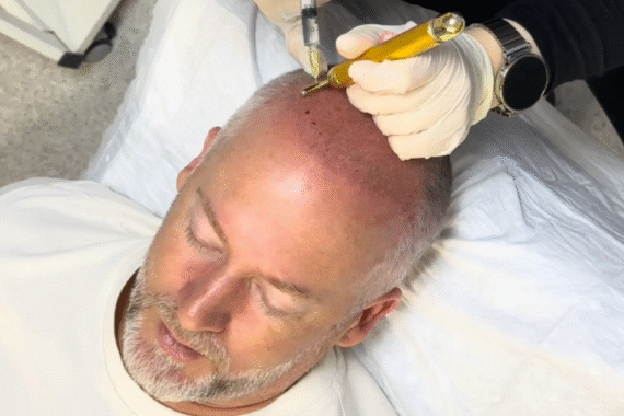 Can Exosomes Therapy Help with Thinning Hair or Bald Spots