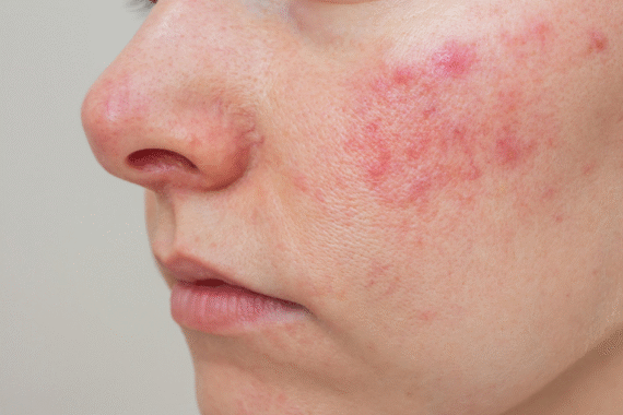 Common Skin Issues and How a Dermatologist Can Help