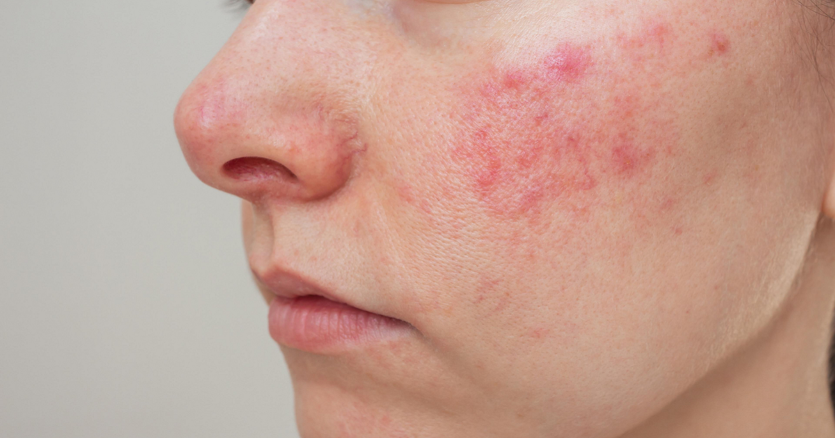 Common Skin Issues and How a Dermatologist Can Help
