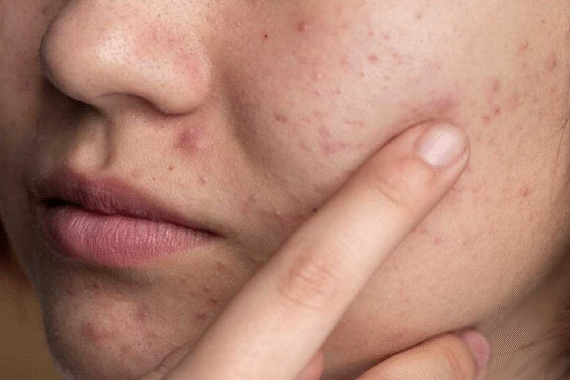 Does Drinking Coffee Affect Your Skin