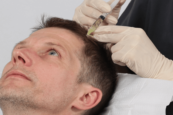 How to Maintain Hair Growth After PRP Sessions