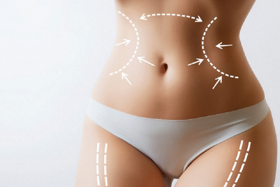 Which Areas of the Body Can Be Treated With Liposuction