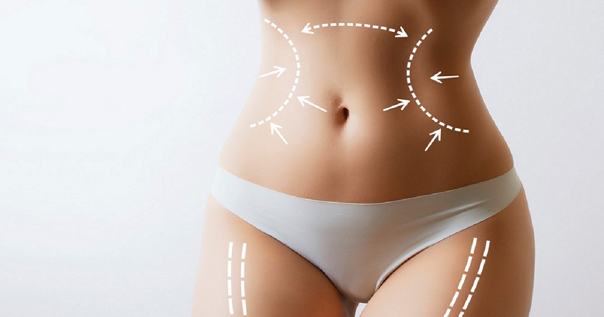 Which Areas of the Body Can Be Treated With Liposuction?