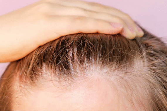 Can Hair Transplant Really Restore a Receding Hairline