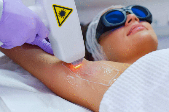 Can Laser Hair Removal Remove Hair Permanently