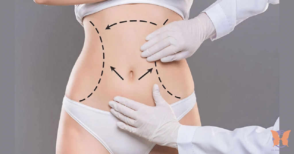 Can Liposuction Remove Stubborn Fat Permanently