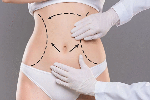 Can Liposuction Remove Stubborn Fat Permanently