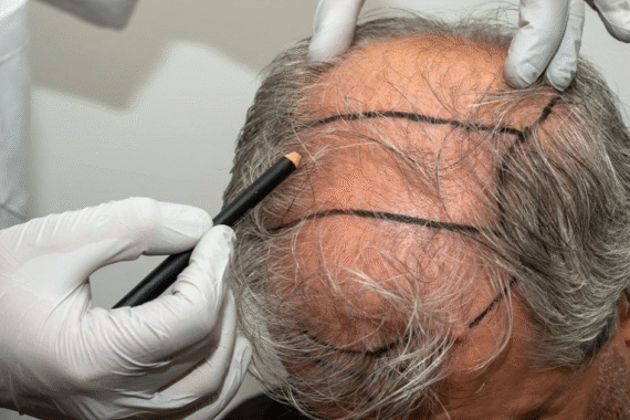 Complete Guide to Hair Transplant Procedure, Cost, and Recovery
