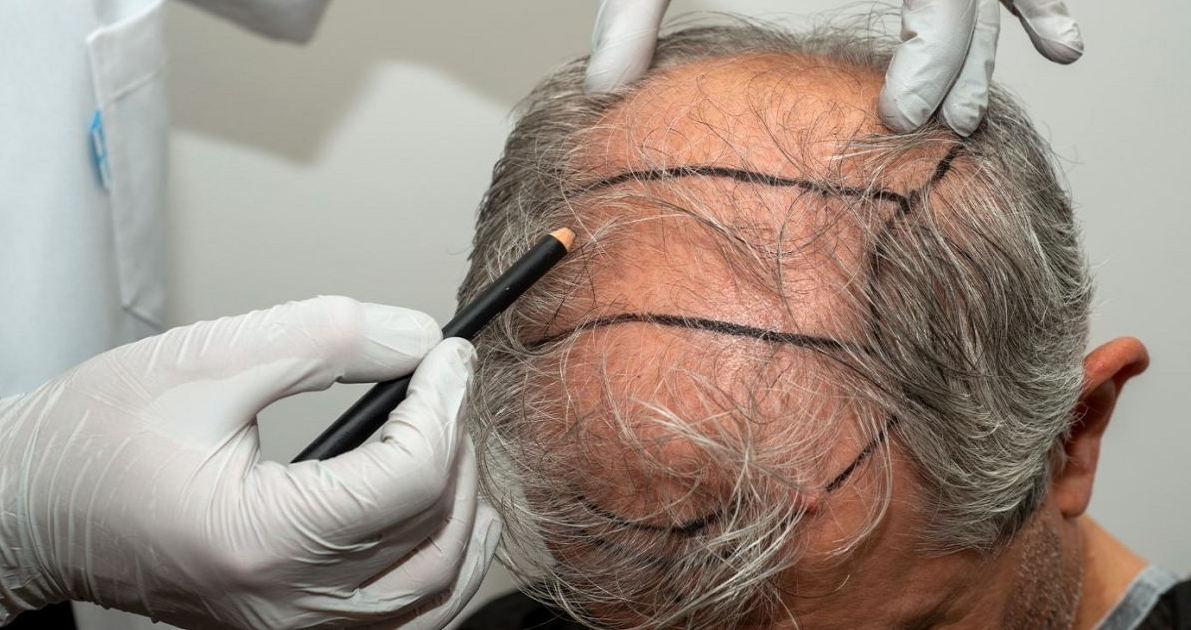 Complete Guide to Hair Transplant: Procedure, Cost, and Recovery