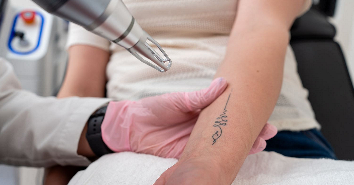 Is Tattoo Removal Safe? Facts, Risks, and Recovery