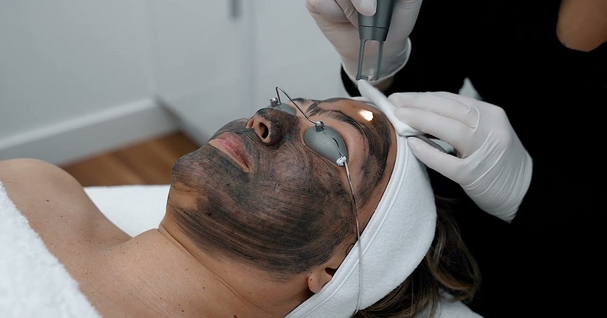 Latest Advancements in Carbon Peel Laser Technology