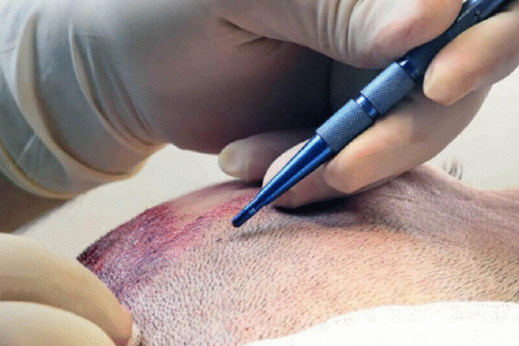 Sapphire FUE Hair Transplant Precision and Natural Results