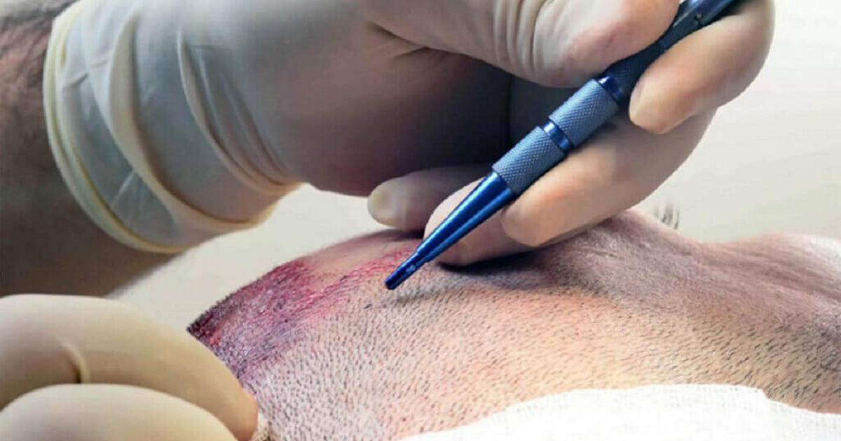 Sapphire FUE Hair Transplant: Precision and Natural Results