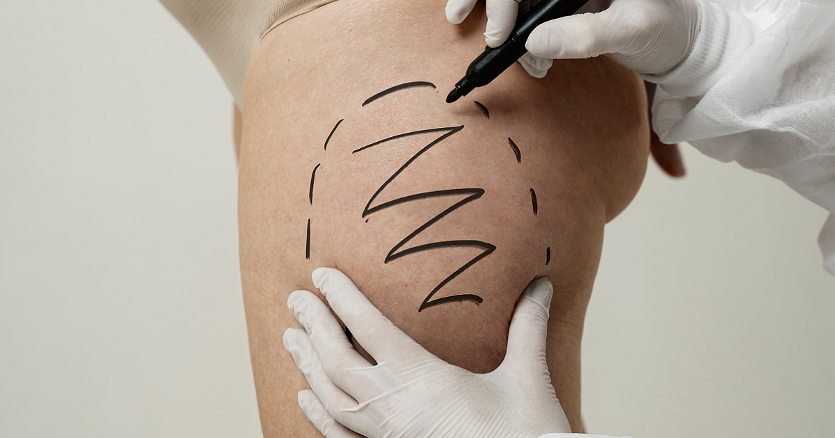 Liposuction for Stubborn Fat in Hips, Thighs, and Abdomen