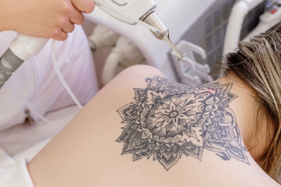 PicoSure vs Q-Switched Laser Which Tattoo Removal Is Better