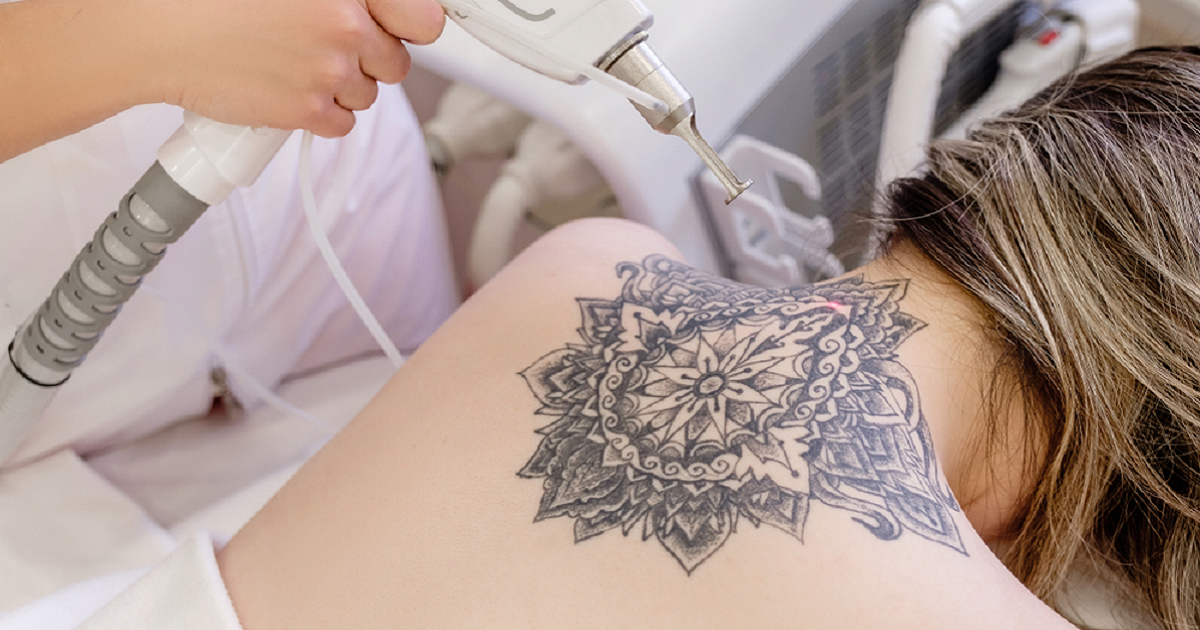 PicoSure vs Q-Switched Laser: Which Tattoo Removal Is Actually Better?