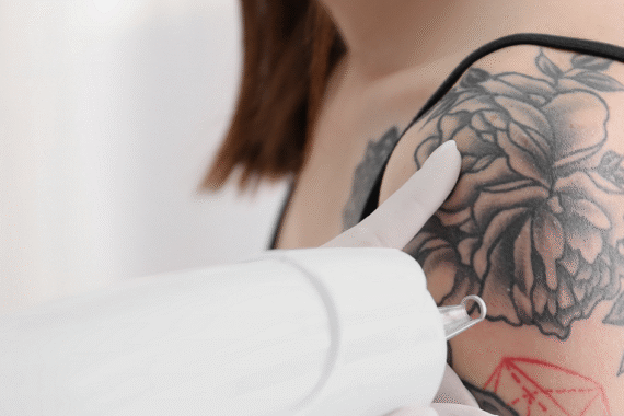 Can All Tattoo Colors Be Removed with Laser Treatment