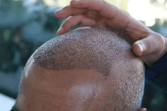 Why Hair Transplants Look More Natural Than Ever Before