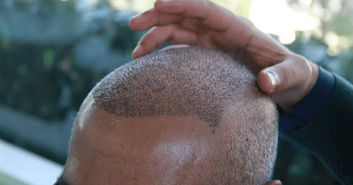 Why Hair Transplants Look More Natural Than Ever Before?