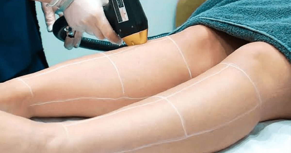 Best Laser Hair Removal Treatment for Pakistani Skin Types
