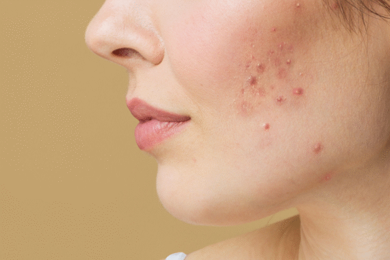 HydraFacial for Acne Does It Really Help Clear Skin