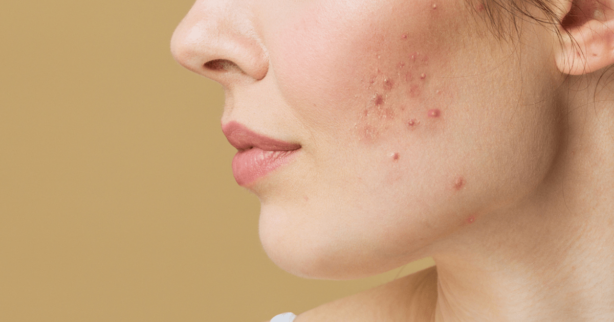 HydraFacial for Acne: Does It Really Help Clear Skin?