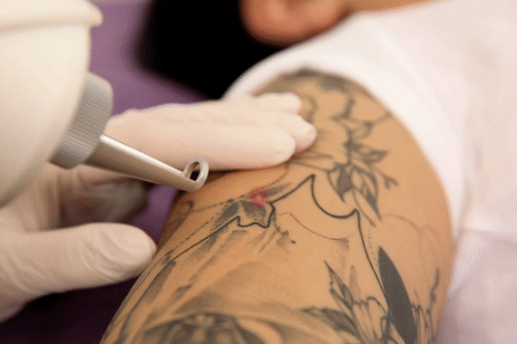 Pico Laser for Tattoo Removal in Islamabad