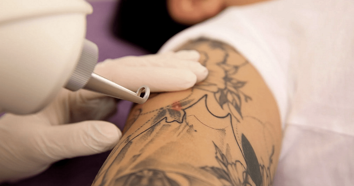 Pico Laser for Tattoo Removal in Islamabad