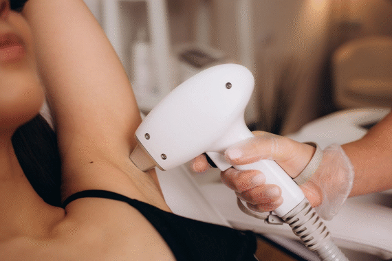 The Ultimate Guide to Smooth Skin with Laser Hair Removal