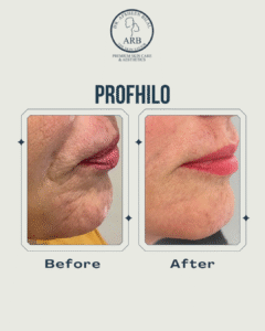 Profhilo Injection Islamabad