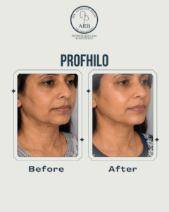 Profhilo Treatment Islamabad