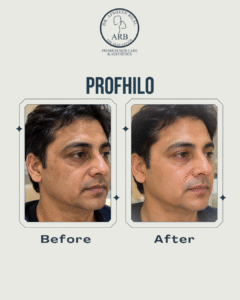 Best Profhilo treatment Islamabad
