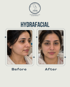 Hydrafacial Islamabad