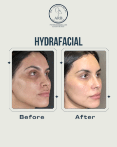 Best hydrafacial Treatment