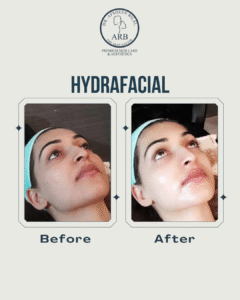 Hydrafacial Treatment Islamabad