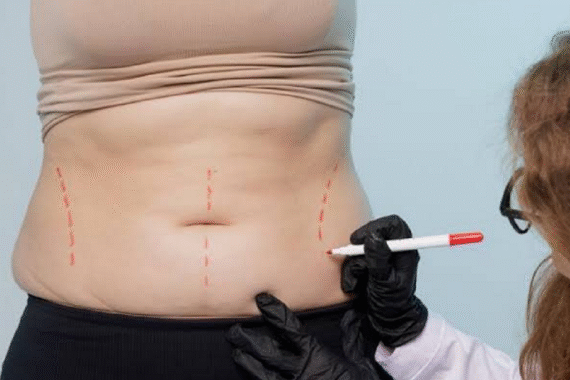 Can Liposuction Remove Belly Fat Permanently
