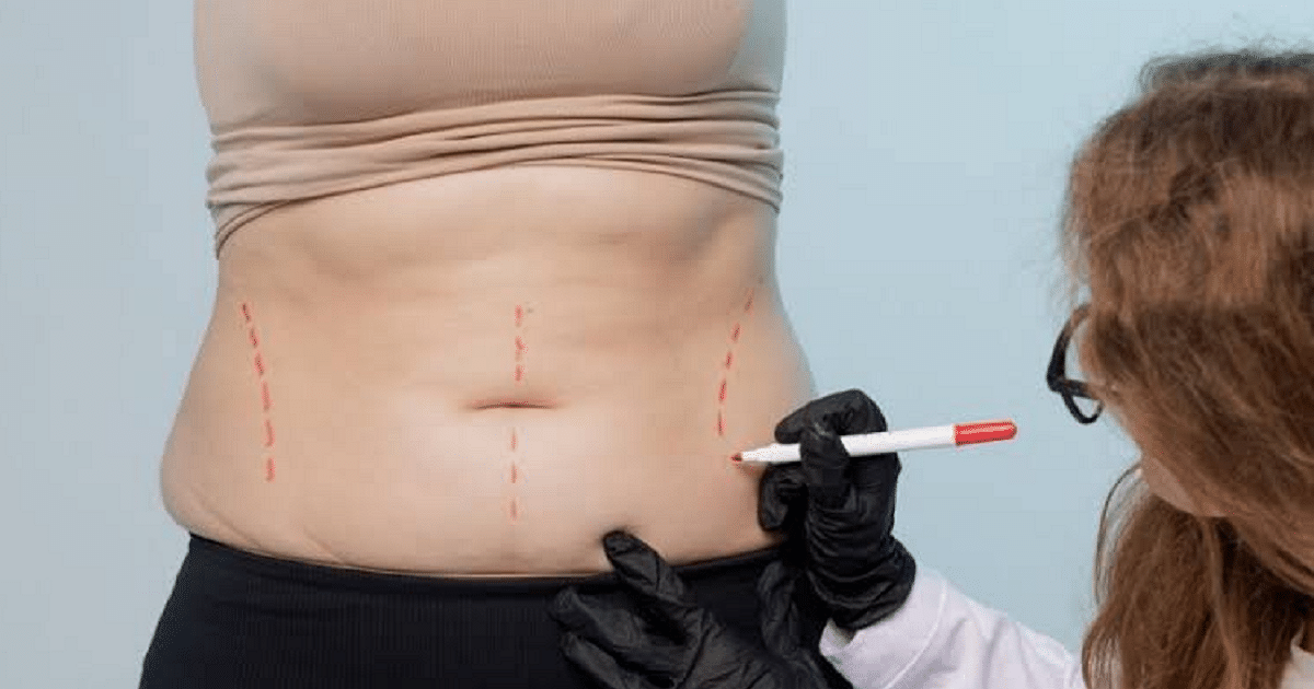 Can Liposuction Remove Belly Fat Permanently?