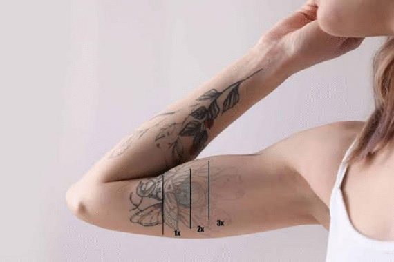 Why Some Tattoos Are Easier to Remove Than Others