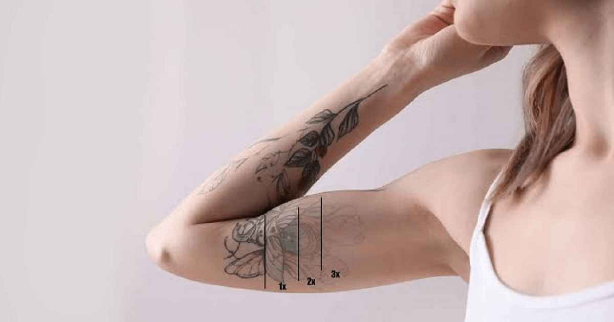 Why Some Tattoos Are Easier to Remove Than Others?
